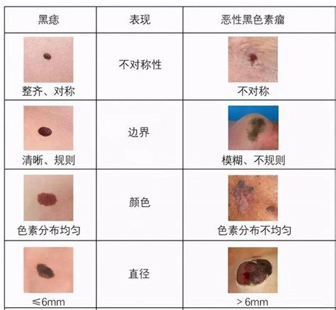 黑色痣|痣（黑素细胞痣）